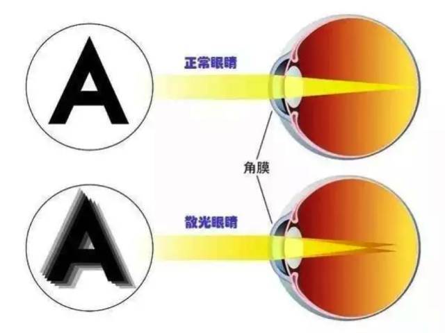 人工视网膜设备助力视力恢复最新研究突破