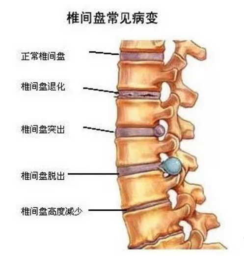 神经假体设备助力脊髓损伤治疗突破