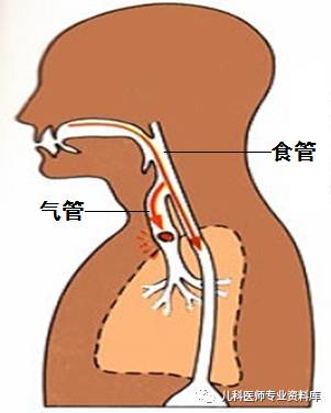 小儿急性呼吸道疾病症状及应急处理要点解析