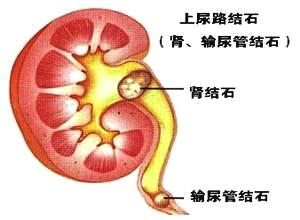 肾结石形成原因与非手术治疗方法探究