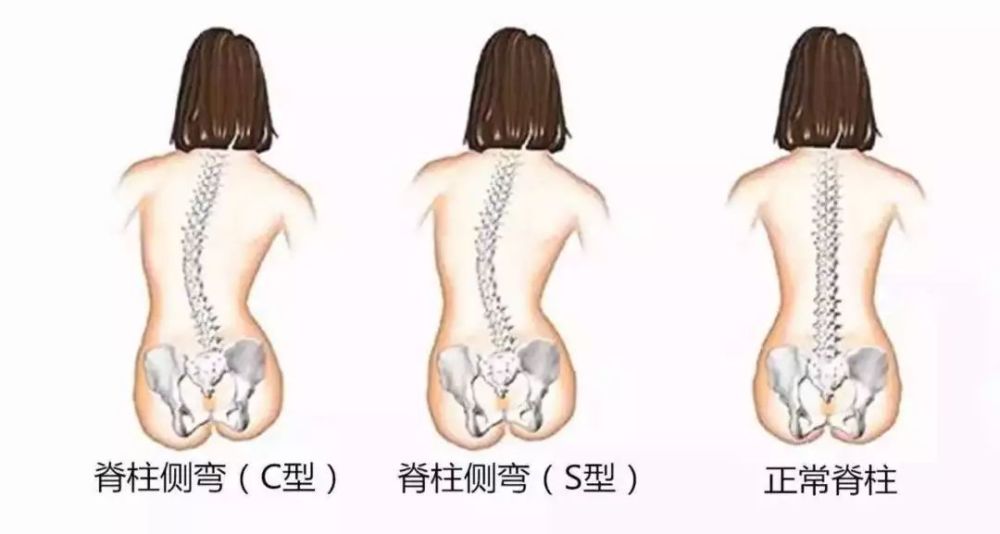 青少年脊柱侧弯的预防及康复治疗方法探讨