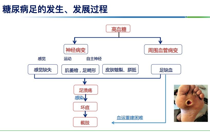 糖尿病并发症预防与定期检查的关键性