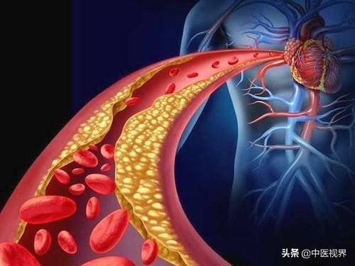 高血脂患者日常饮食关键禁忌解析