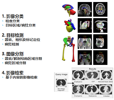 数字医疗影像分析助力癌症诊断进步