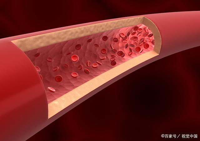血脂控制对预防动脉硬化的关键作用
