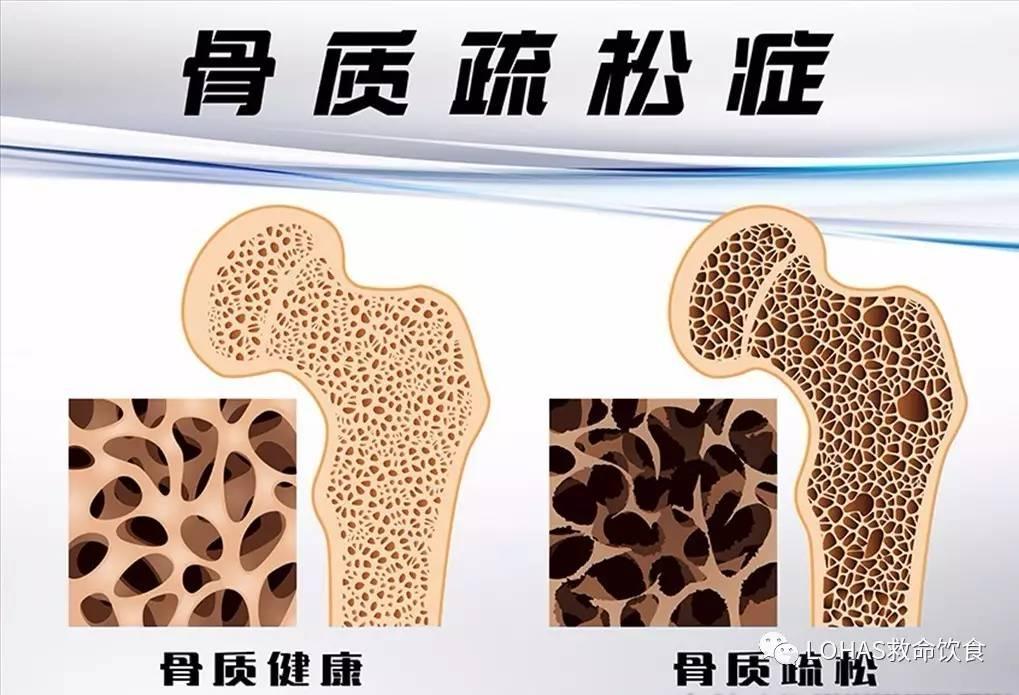 锻炼对老年人骨质密度的保护与影响研究