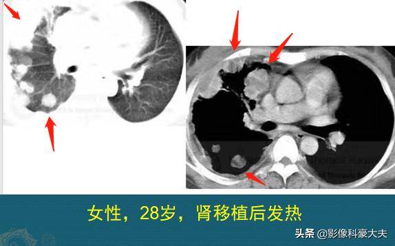 中医方法助你增强肺部免疫力